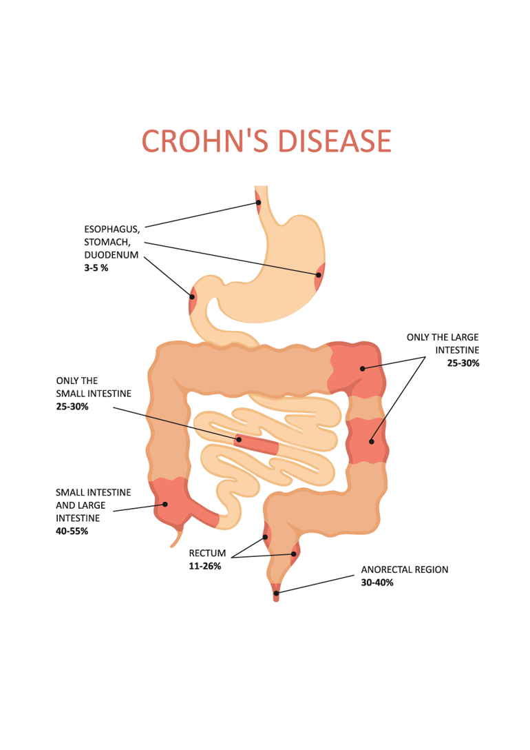 Crohn's Disease Dubai Gastroenterology Clinic